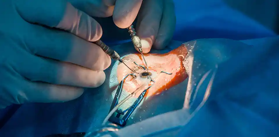 Cataract Surgery Cost Procedure and Risk