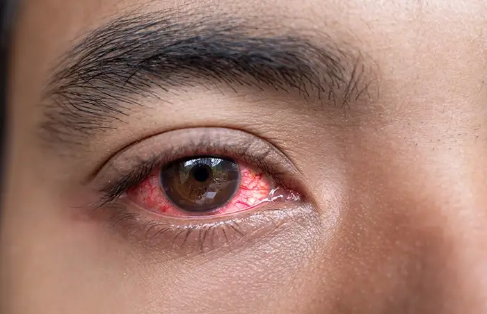 eye specialists treat endophthalmitis