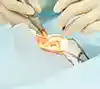 LASIK with SMILE procedure